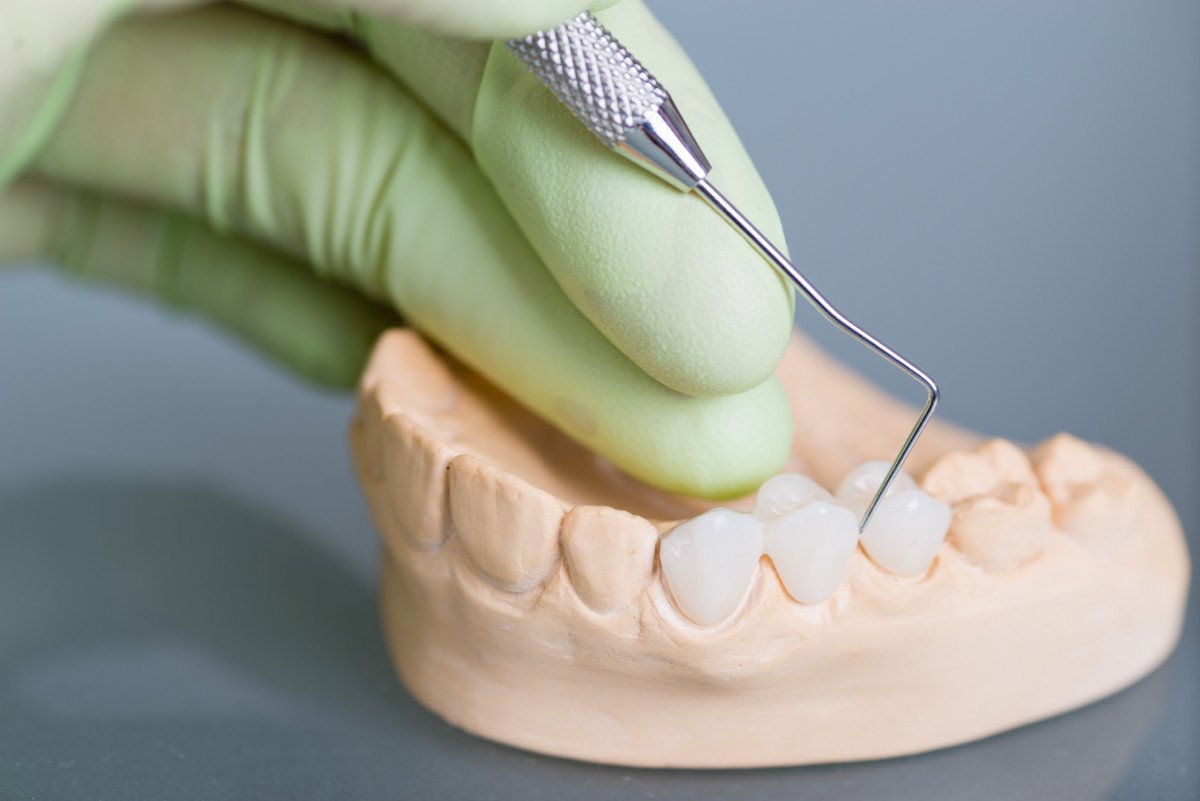 стоматология мост зубов