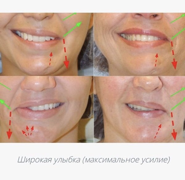 Опускать губа. Улыбка с опущенными уголками губ. Приподнять уголки губ ботоксом.