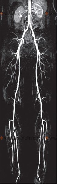 Вены нижних конечностей кт. Кт-ангиография артерий нижних конечностей. Анатомия артерий нижних конечностей кт ангиография. Кт сосудов нижних конечностей с контрастированием. Магнитно-резонансная ангиография сосудов нижних конечностей.