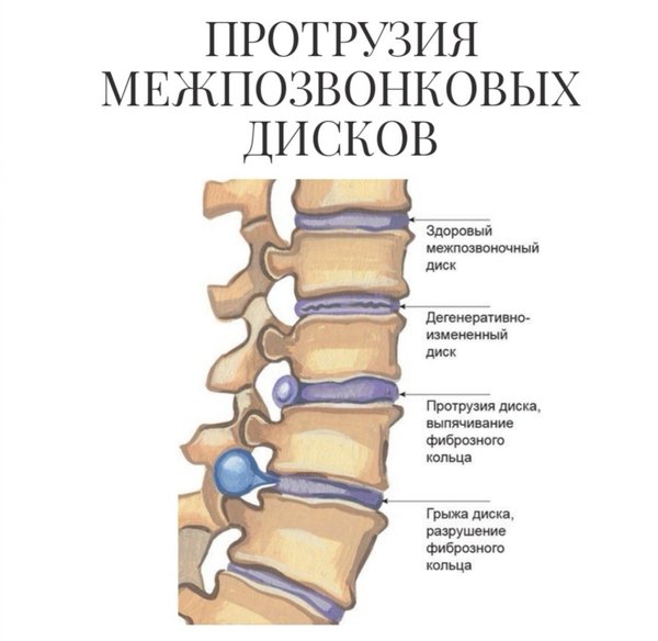 Протрузия дисков шейного отдела с3 с5
