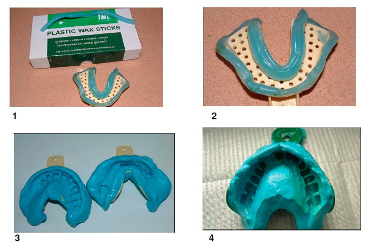 Клинико лабораторные этапы съемных пластиночных протезов. Этапы изготовления иммедиат протеза. Иммедиат протез ортопедия. Косметическая пластинка для зубов. Наборы зубов для съемных протезов.