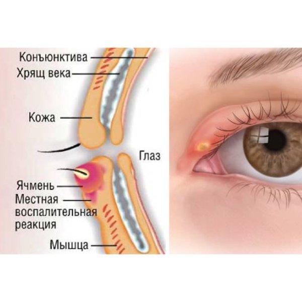 Халязион схема лечения