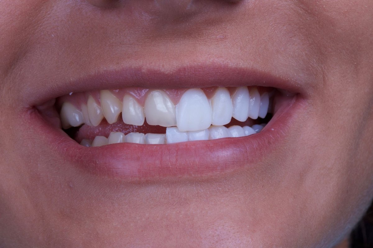 Изменение формы зубов. Красивые зубы. Красивая форма зубов.